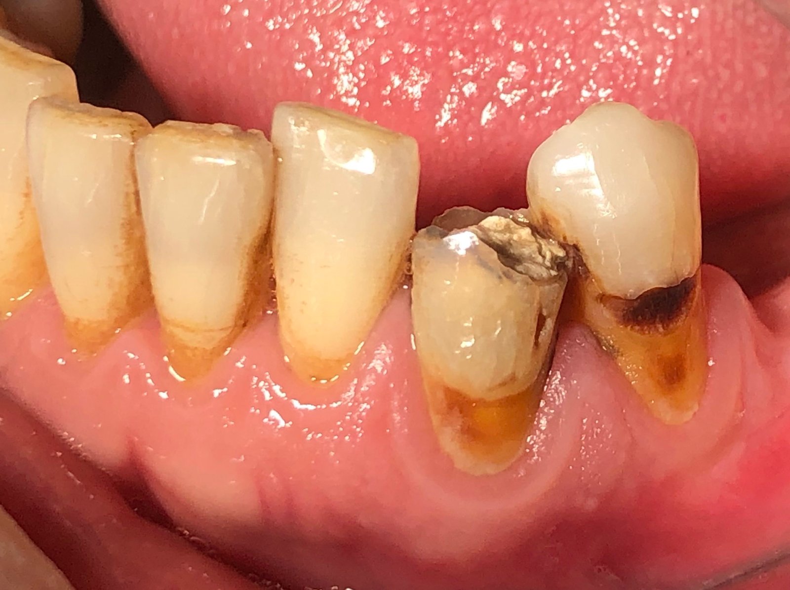 Dentadura antes de un tratamiento