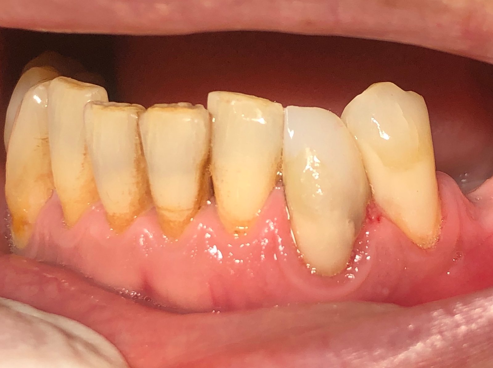 Dentadura después de un tratamiento