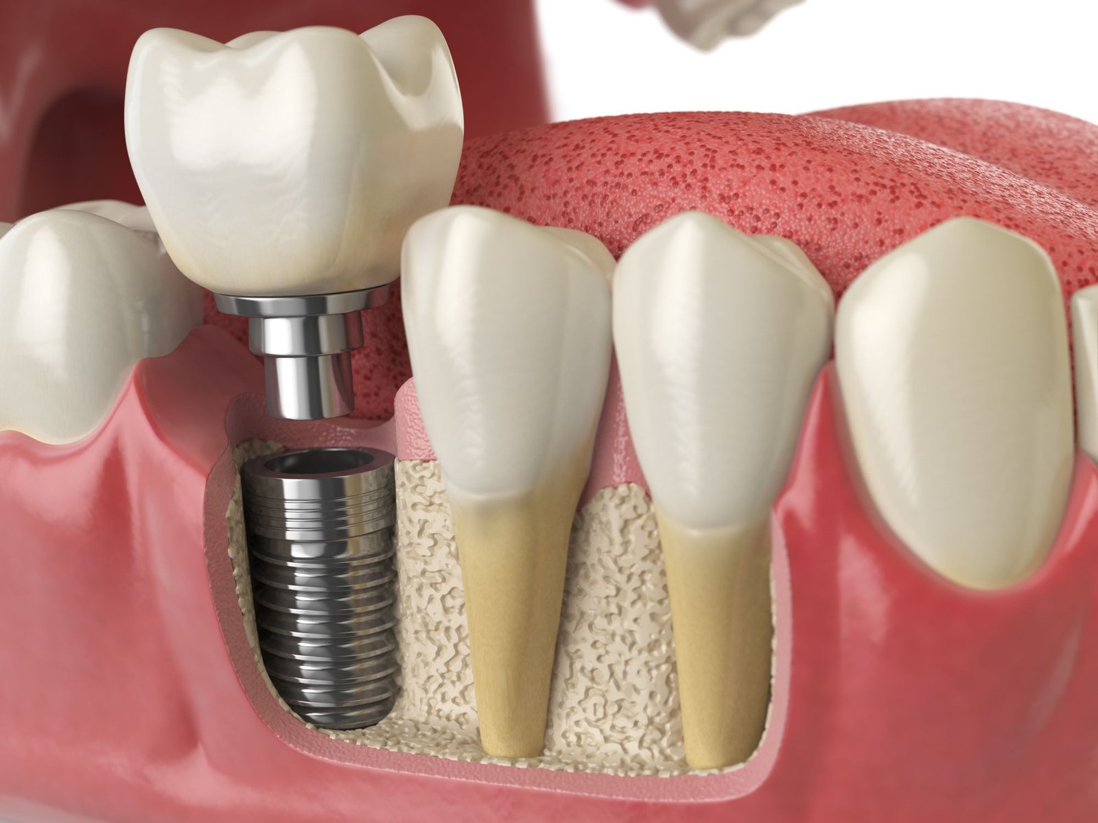 tratamientos dentales de implantes