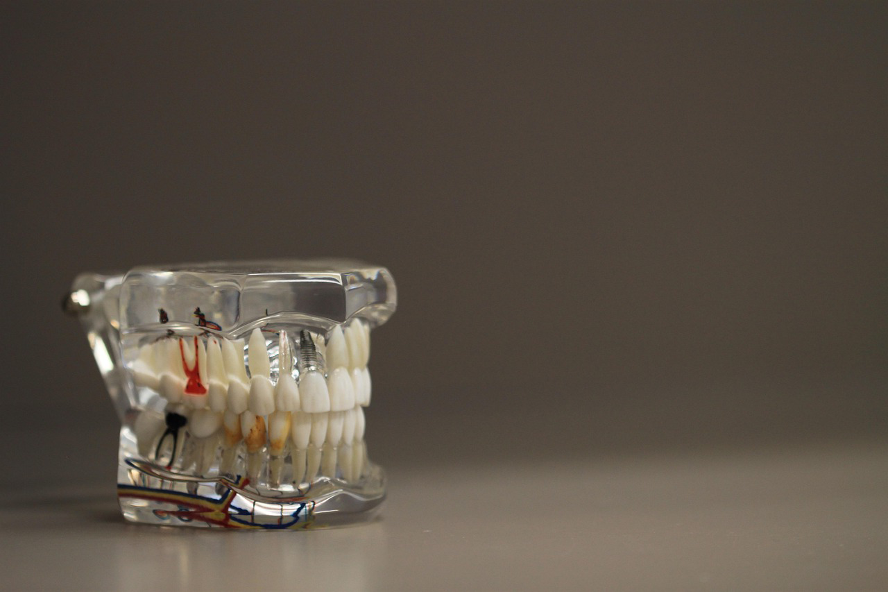 ejemplo de prótesis dental