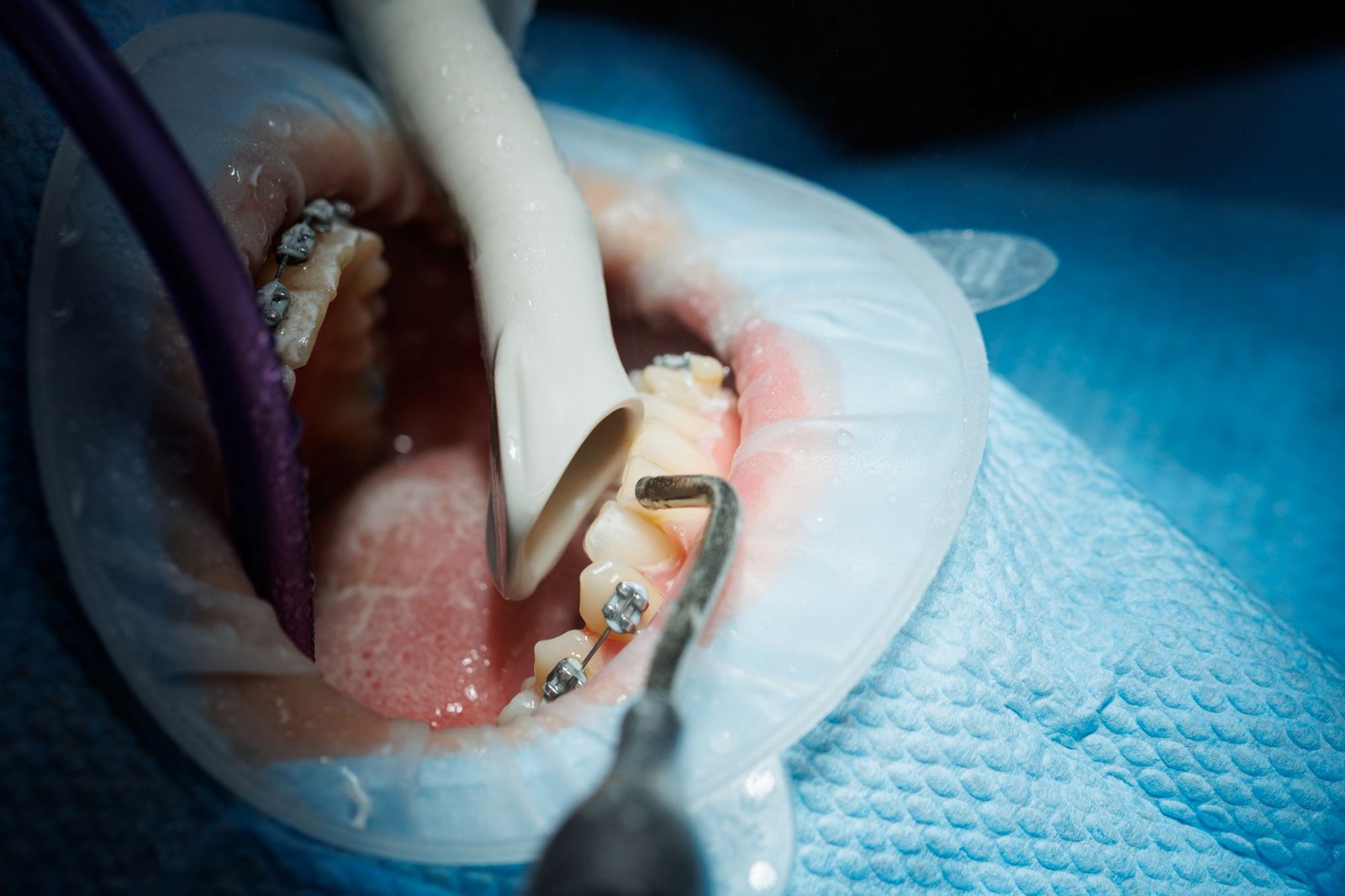 Tratamientos conservadores para salvar un diente antes de extraerlo