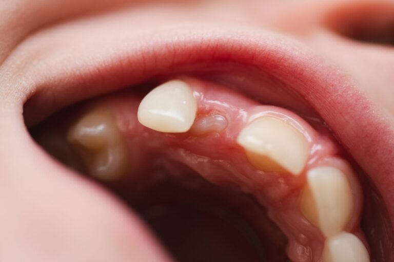 caries entre dientes en niños
