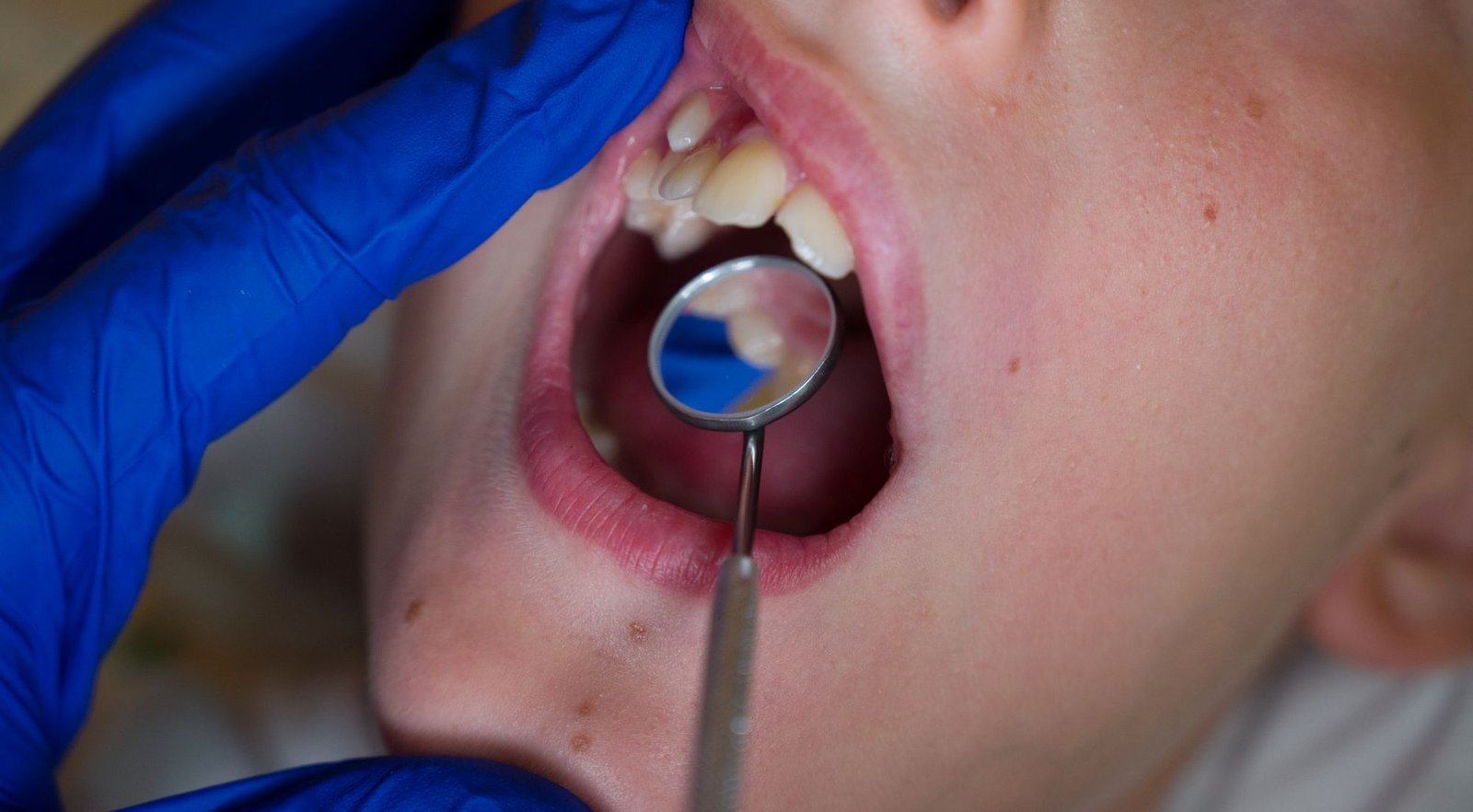 diente definitivo sale detrás del de leche