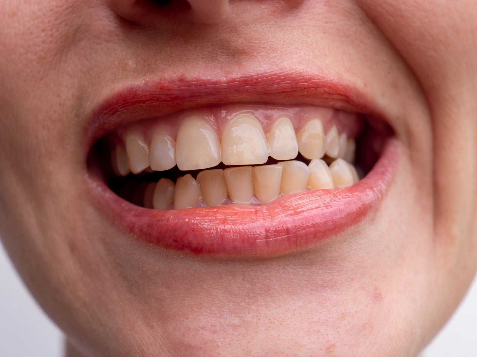 manchas en los dientes