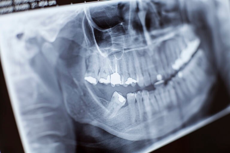radiografía dental