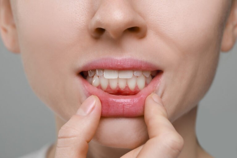 encías inflamadas