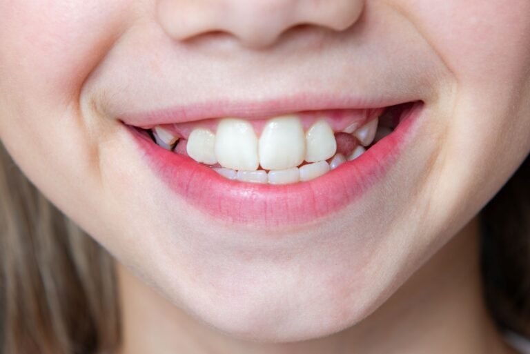 dientes torcidos