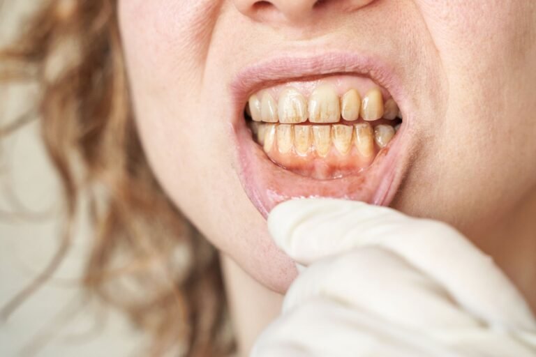 manchas en los dientes