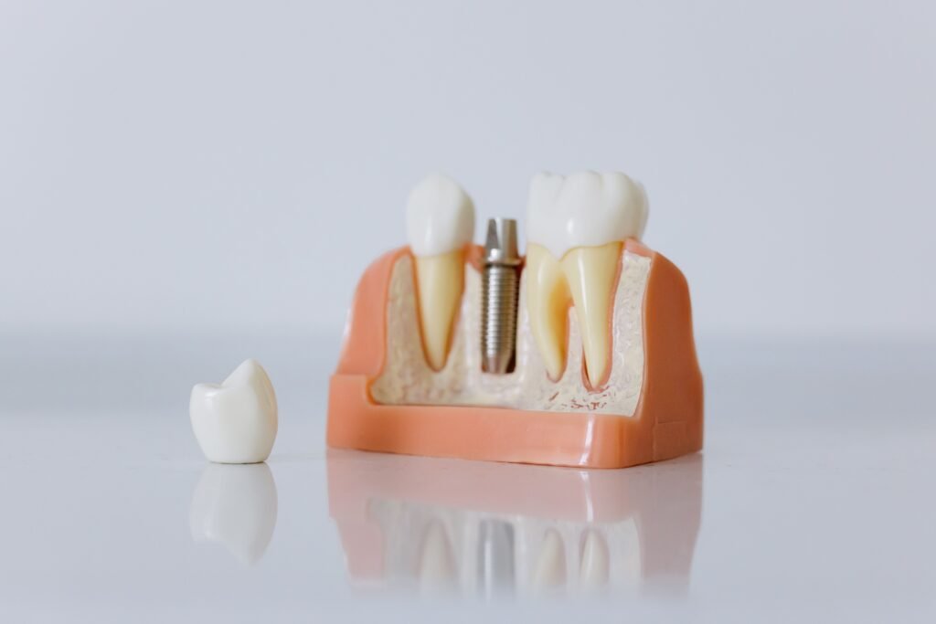 Imagen de un implante dental