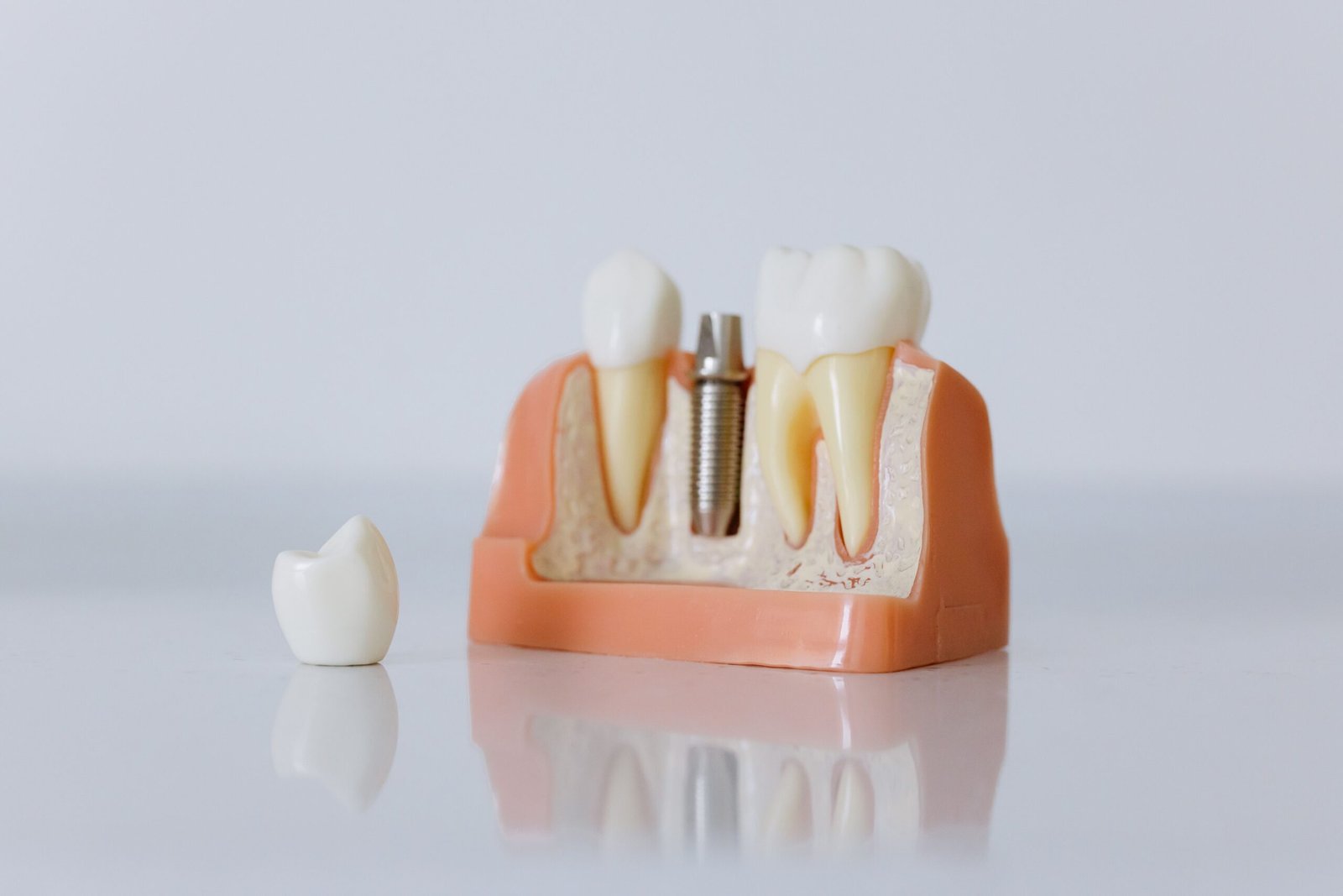 Imagen de un implante dental