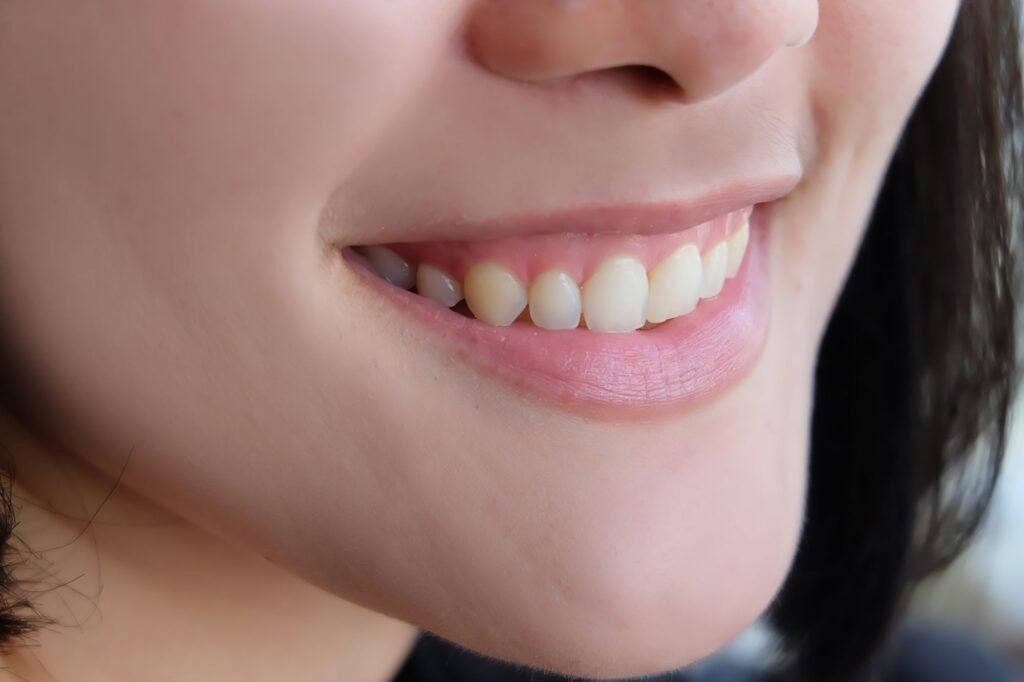 sonrisa gingival