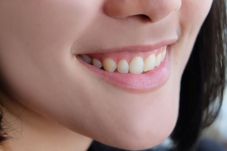 sonrisa gingival