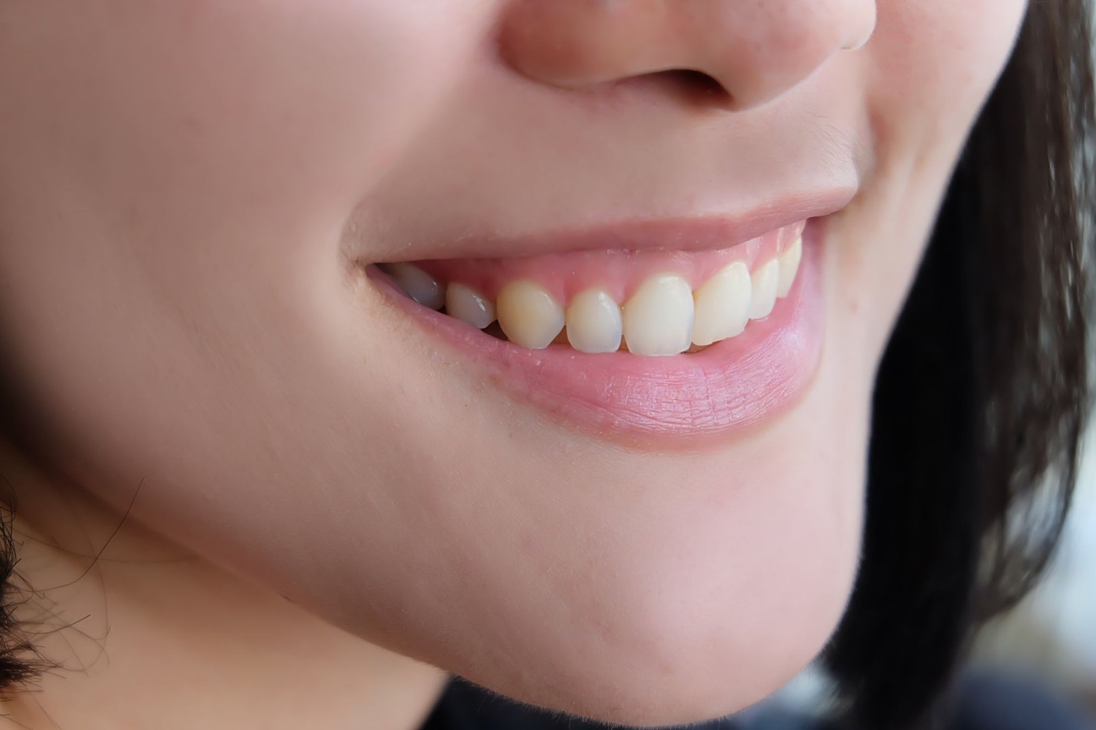 sonrisa gingival